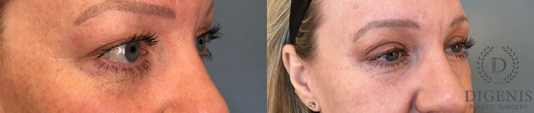 Before and after Eye Lid Surgery case 41341 - Angle 4