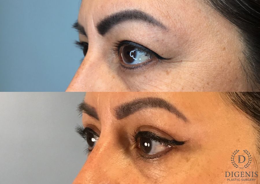 Before and after Eye Lid Surgery case 49483 - Angle 2
