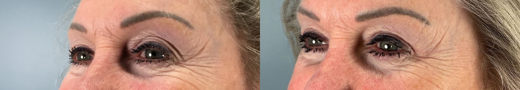 Before and after Eye Lid Surgery case 49986 - Angle 2