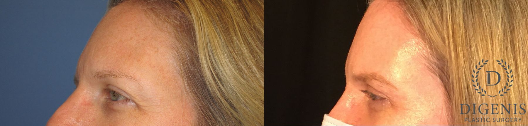 Before and after Eye Lid Surgery case 35097 - Angle 3