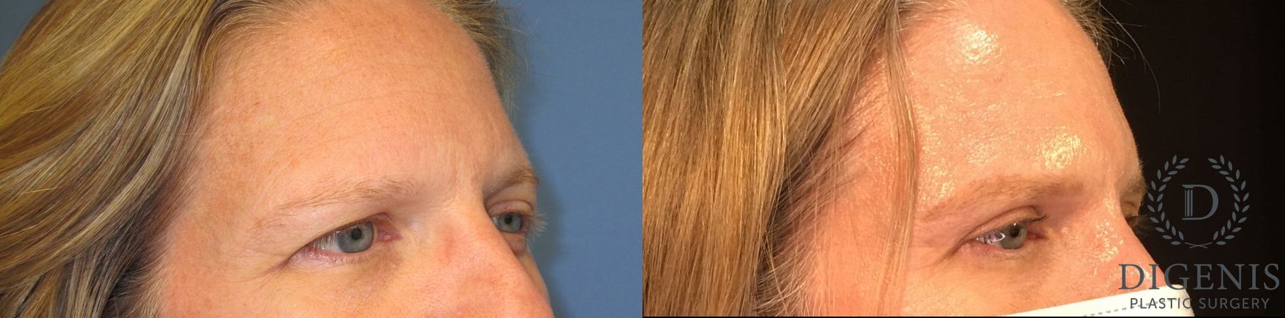 Before and after Eye Lid Surgery case 35097 - Angle 2