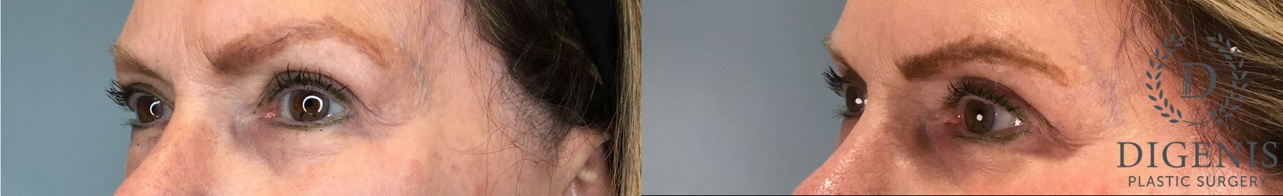 Before and after Eye Lid Surgery case 43261