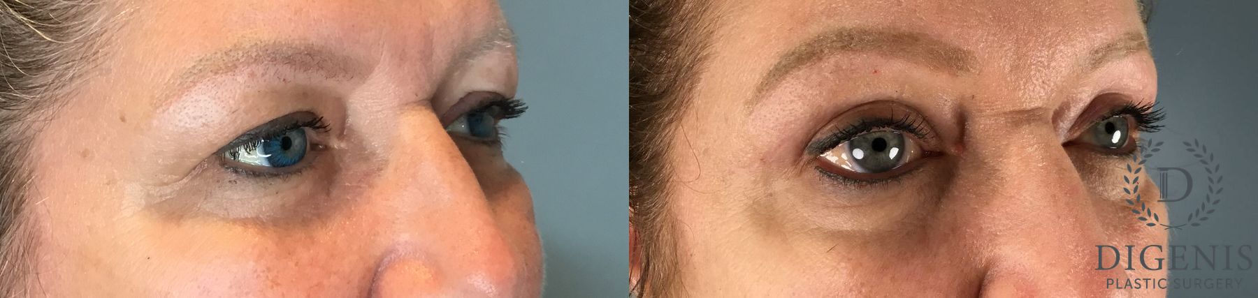 Before and after Eye Lid Surgery case 41693 - Angle 2