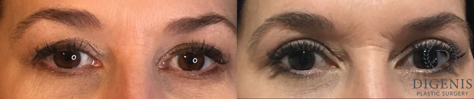 Before and after Eye Lid Surgery case 35189