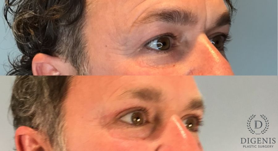Before and after Eye Lid Surgery case 46363 - Angle 2