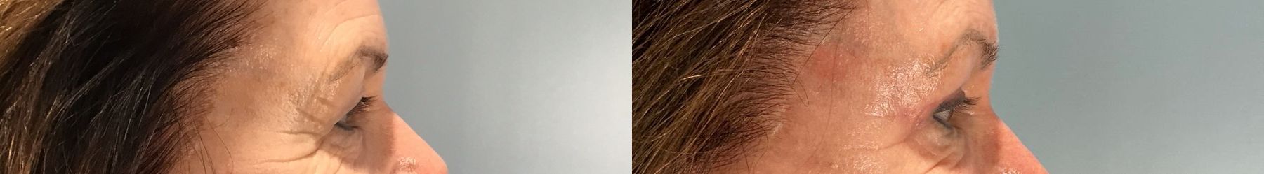 Before and after Eye Lid Surgery case 49984 - Angle 3