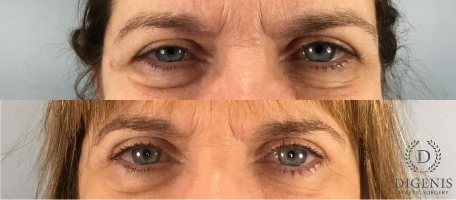 Before and after Eye Lid Surgery case 49395