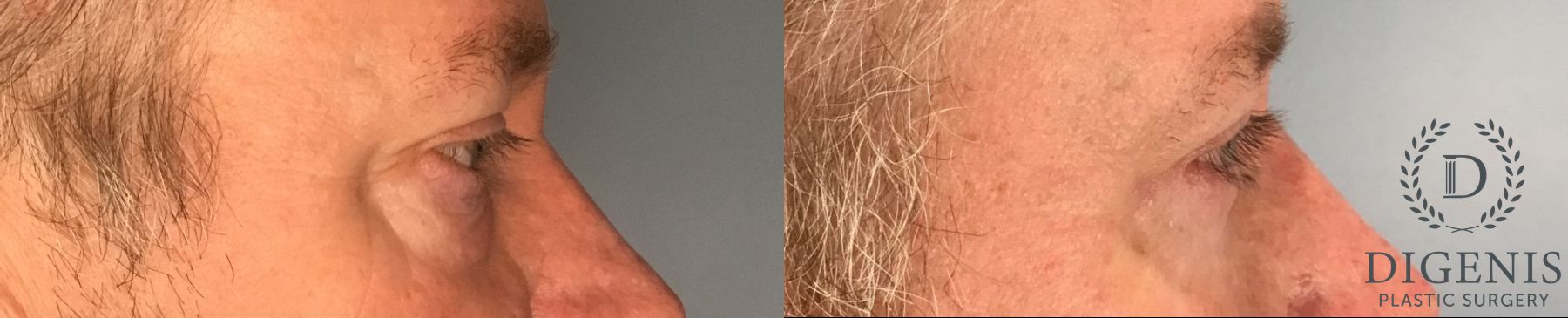 Before and after Eye Lid Surgery case 41739 - Angle 4