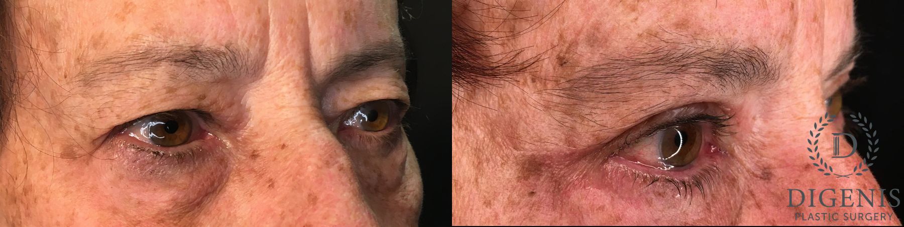 Before and after Eye Lid Surgery case 35193 - Angle 2