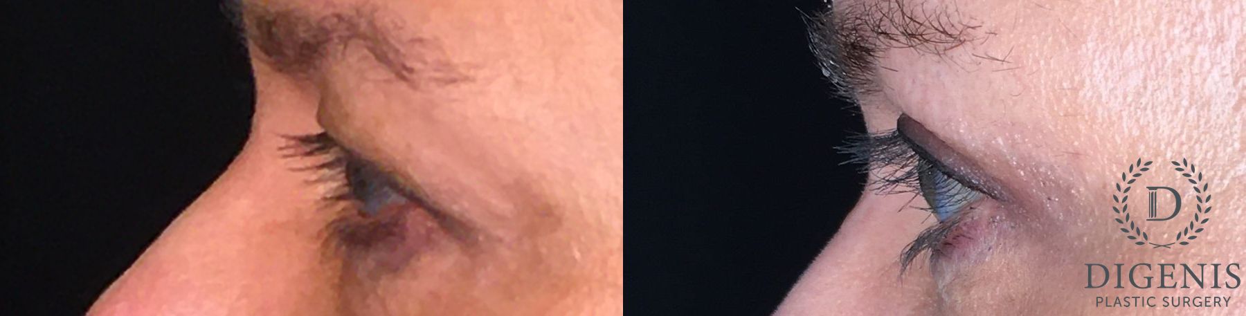 Before and after Eye Lid Surgery case 35161 - Angle 3