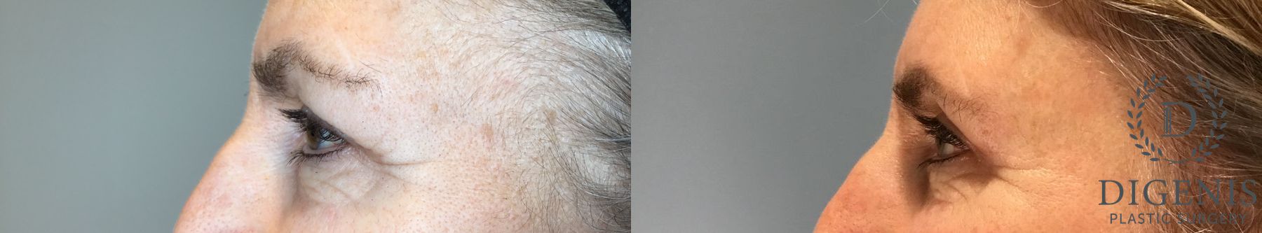 Before and after Eye Lid Surgery case 46243 - Angle 5