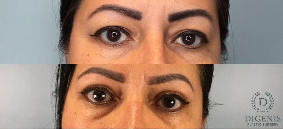 Before and after Eye Lid Surgery case 49483