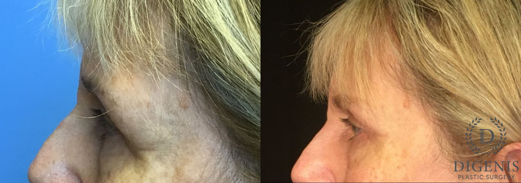 Before and after Eye Lid Surgery case 35109 - Angle 5