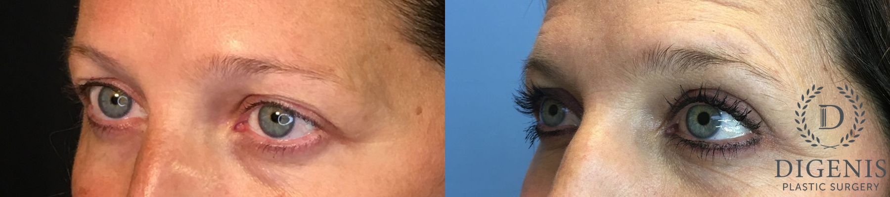 Before and after Eye Lid Surgery case 35147 - Angle 4