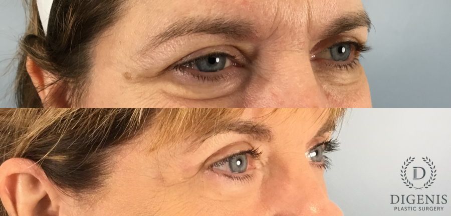 Before and after Eye Lid Surgery case 49395 - Angle 4
