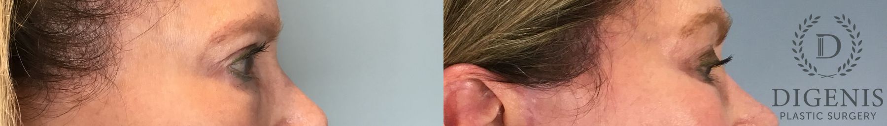 Before and after Eye Lid Surgery case 43261 - Angle 4