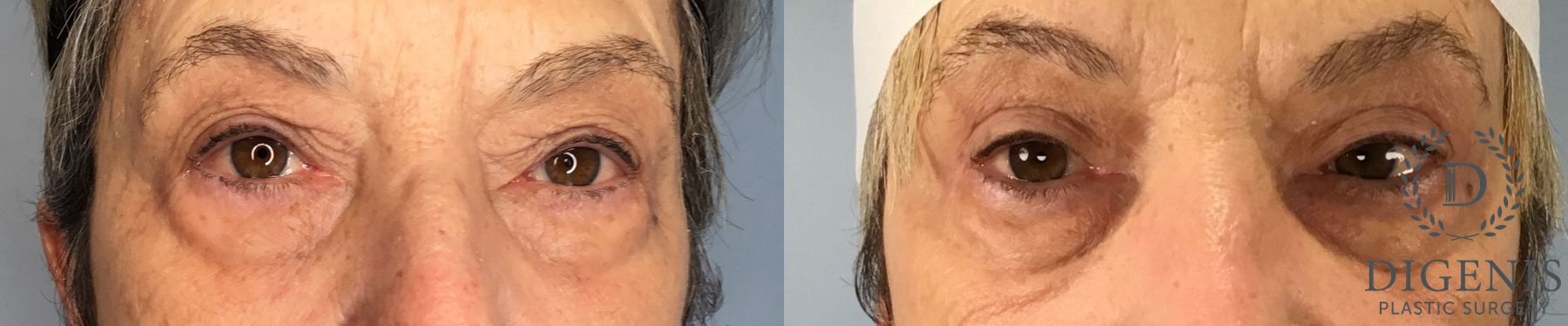Before and after Eye Lid Surgery case 41677