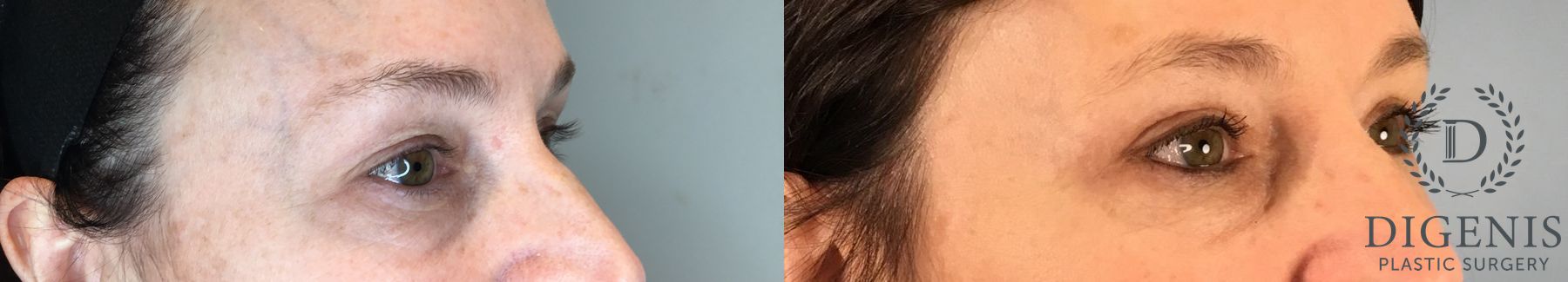 Before and after Eye Lid Surgery case 43361 - Angle 2