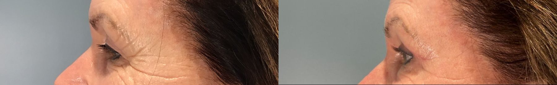 Before and after Eye Lid Surgery case 49984 - Angle 5