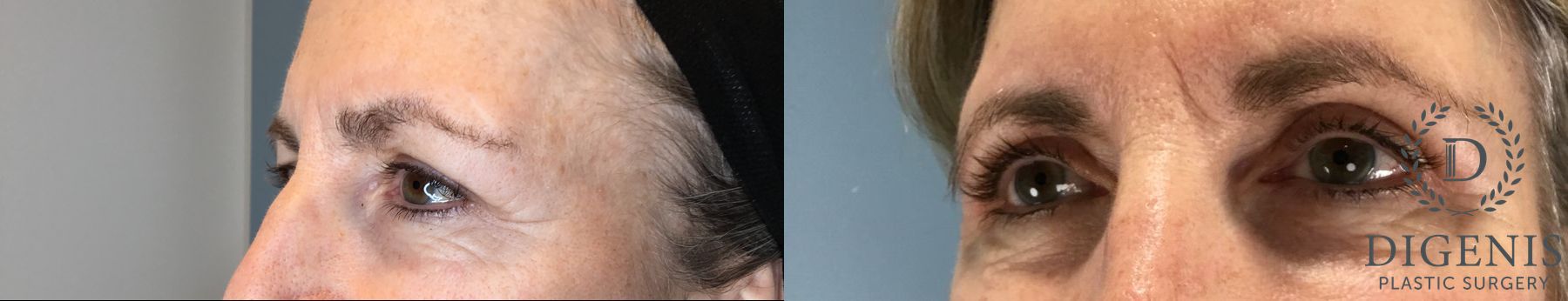 Before and after Eye Lid Surgery case 46243 - Angle 4