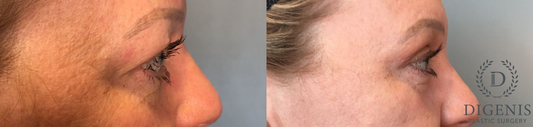 Before and after Eye Lid Surgery case 41341 - Angle 5