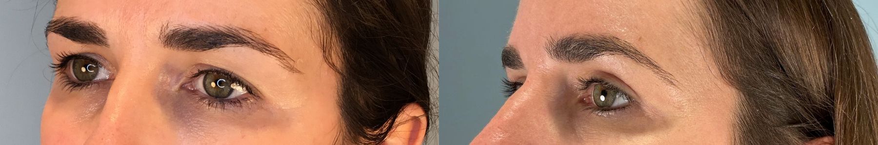 Before and after Eye Lid Surgery case 49981 - Angle 4