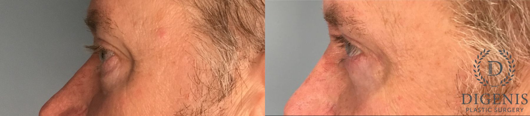 Before and after Eye Lid Surgery case 41739 - Angle 2