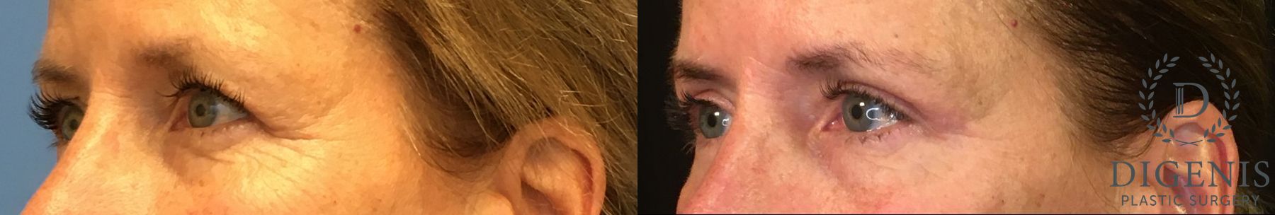 Before and after Eye Lid Surgery case 35059 - Angle 4