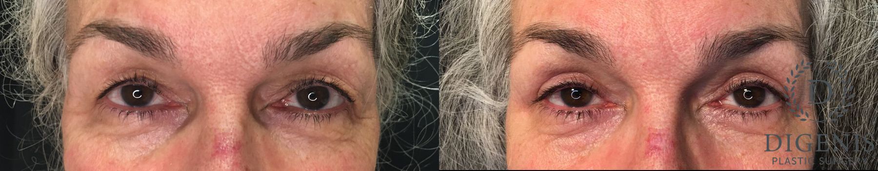 Before and after Eye Lid Surgery case 35171