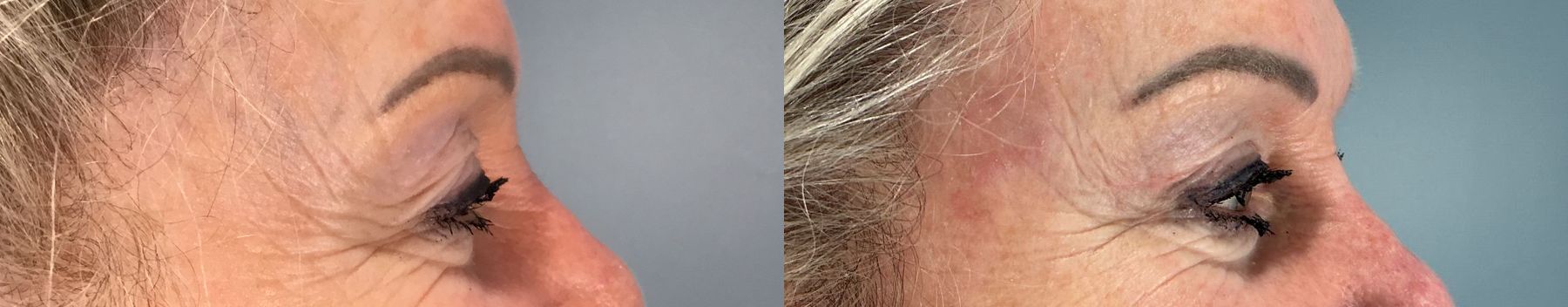 Before and after Eye Lid Surgery case 49986 - Angle 5