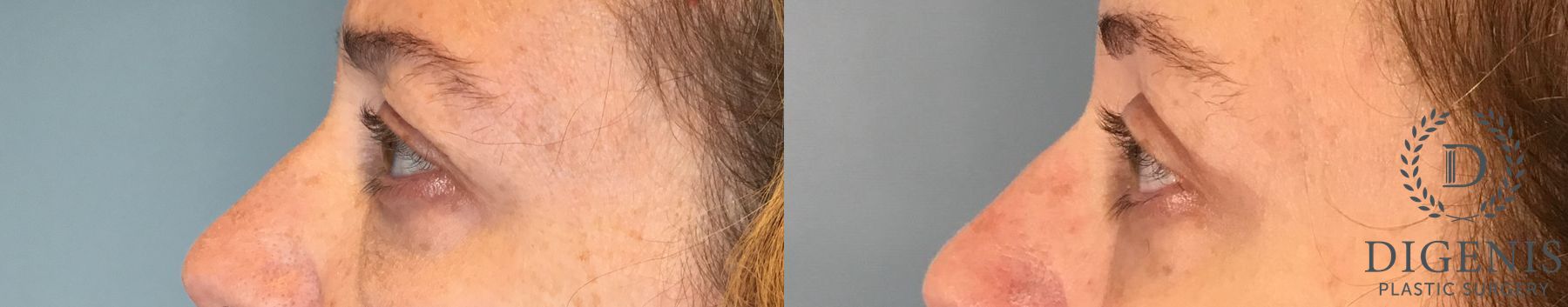 Before and after Eye Lid Surgery case 43430 - Angle 5