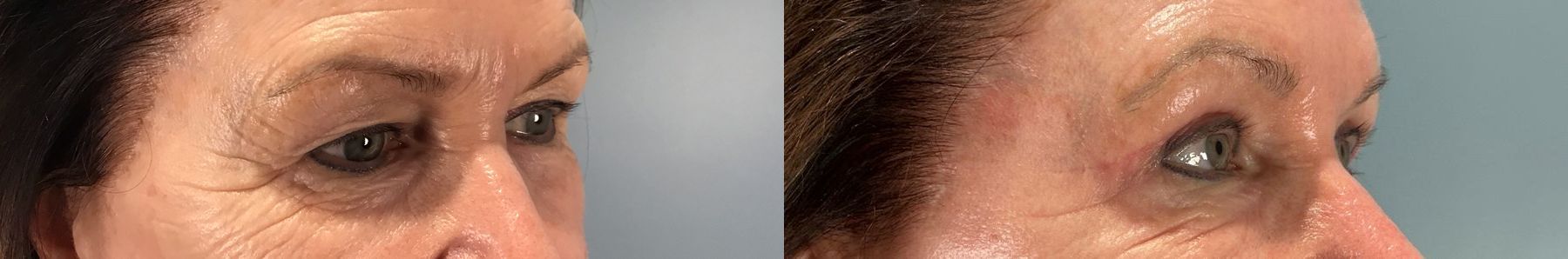 Before and after Eye Lid Surgery case 49984 - Angle 2