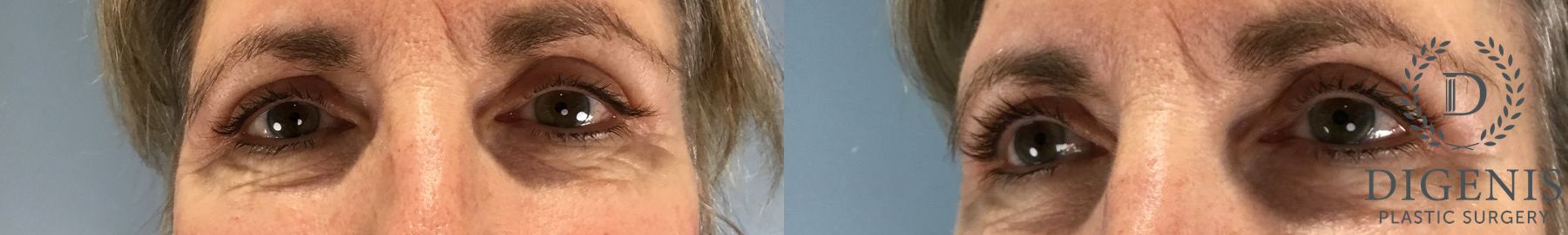 Before and after Eye Lid Surgery case 46243 - Angle 6