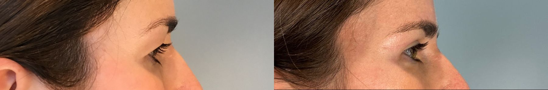 Before and after Eye Lid Surgery case 49981 - Angle 3