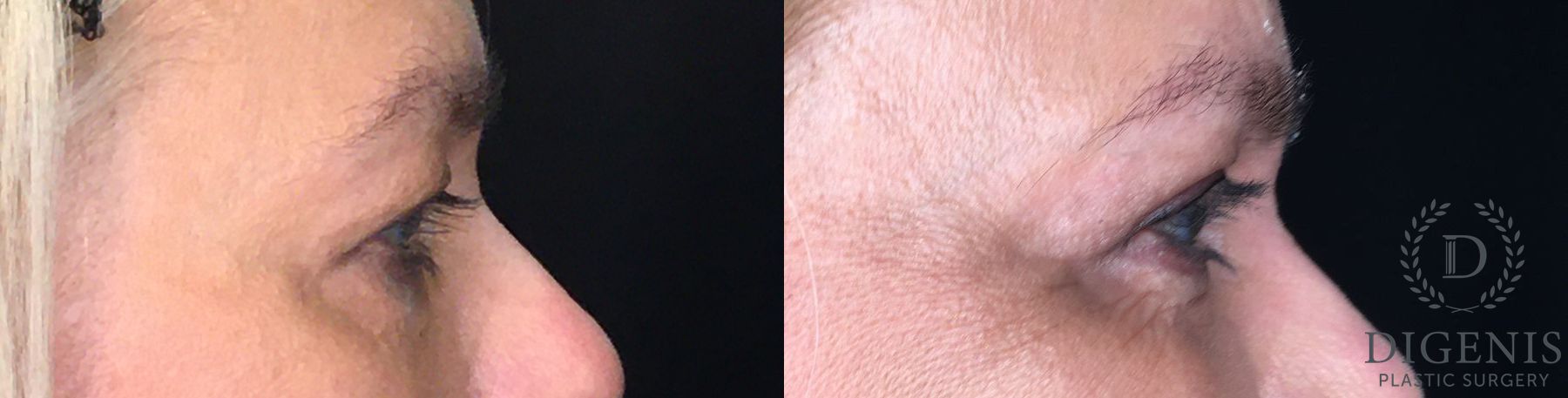 Before and after Eye Lid Surgery case 35161 - Angle 5