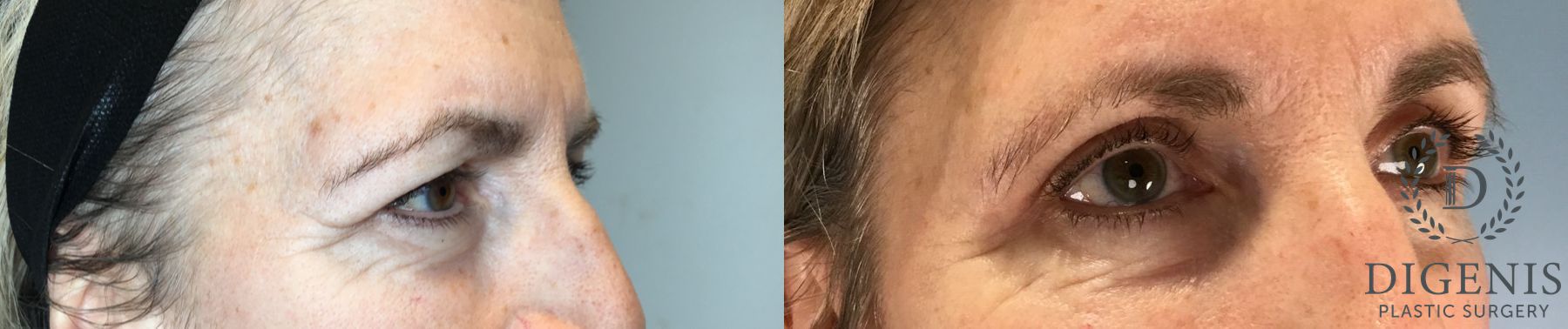 Before and after Eye Lid Surgery case 46243 - Angle 2