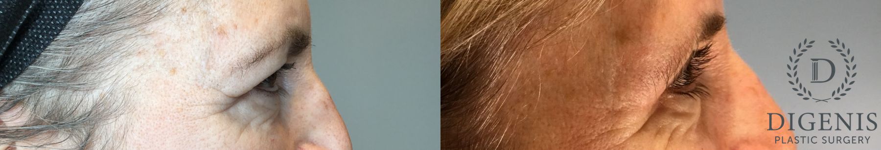 Before and after Eye Lid Surgery case 46243 - Angle 3