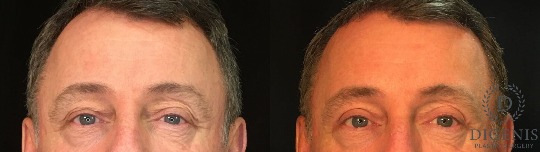 Before and after Eye Lid Surgery case 35029