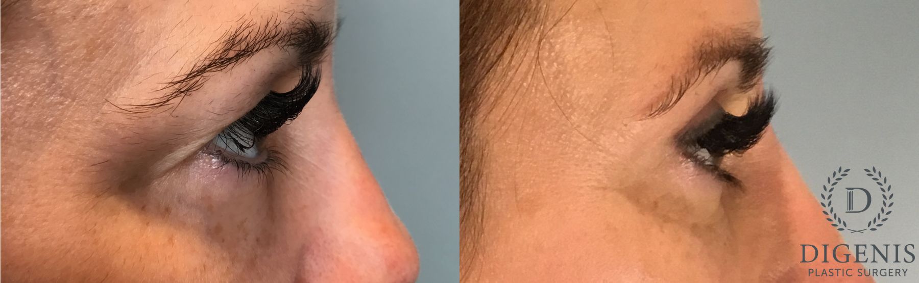 Before and after Eye Lid Surgery case 41732 - Angle 3