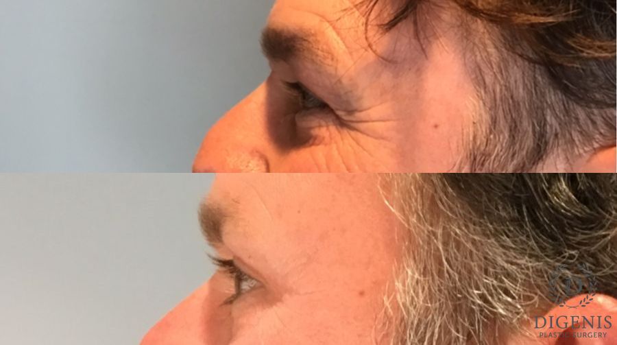 Before and after Eye Lid Surgery case 46363 - Angle 5