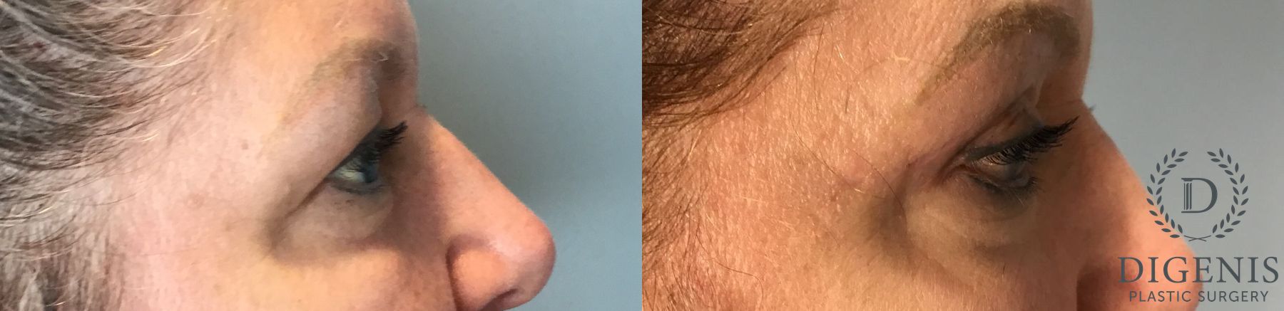 Before and after Eye Lid Surgery case 41693 - Angle 3