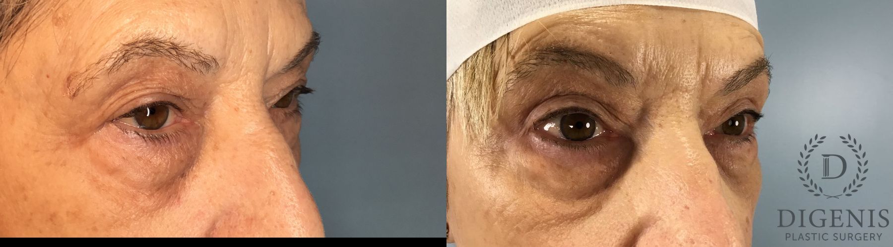 Before and after Eye Lid Surgery case 41677 - Angle 4