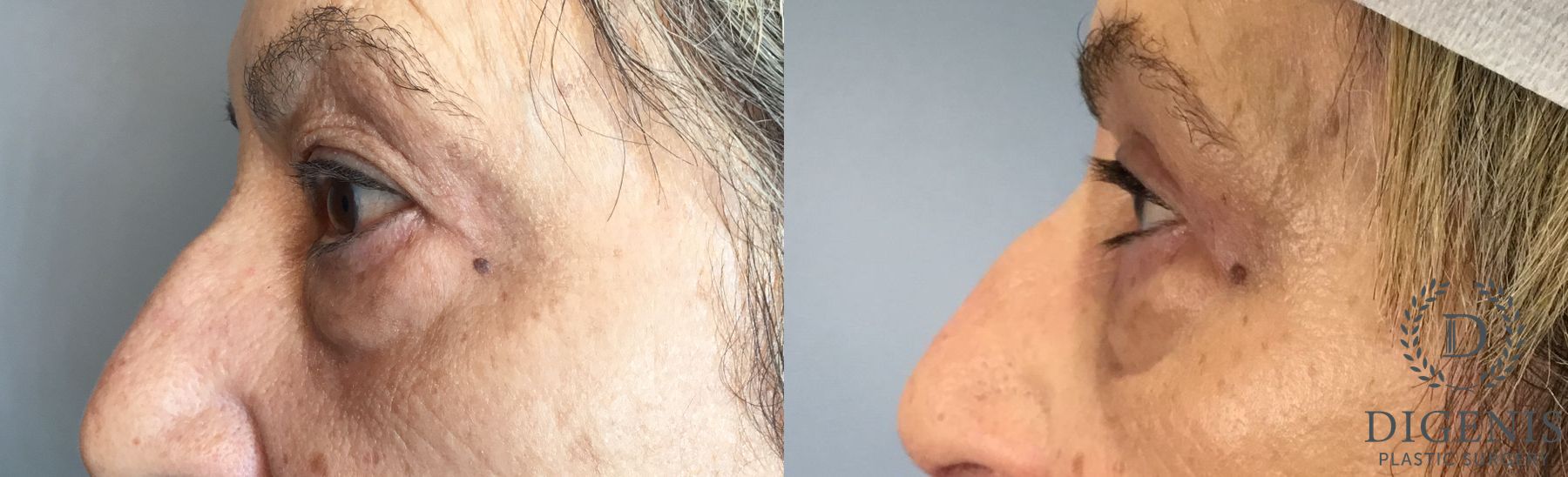 Before and after Eye Lid Surgery case 41677 - Angle 3
