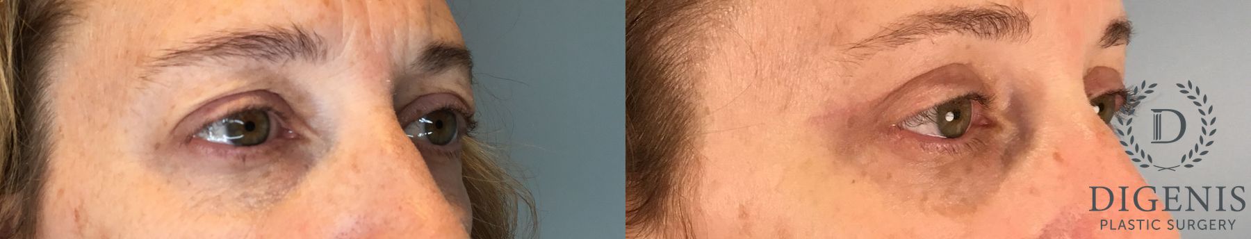 Before and after Eye Lid Surgery case 43430 - Angle 2