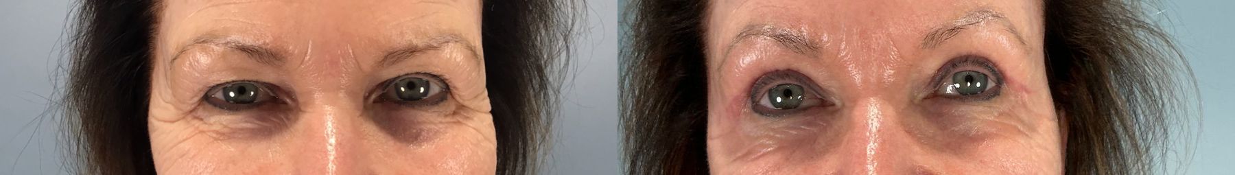Before and after Eye Lid Surgery case 49984