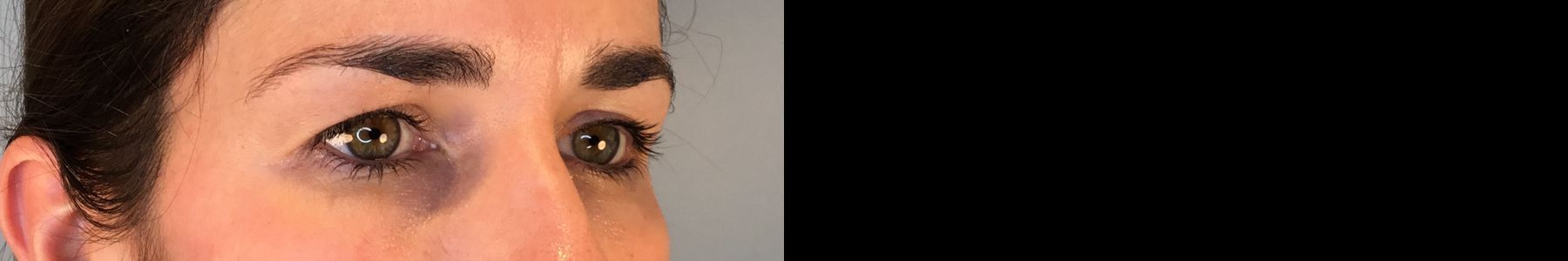 Before and after Eye Lid Surgery case 49981 - Angle 2
