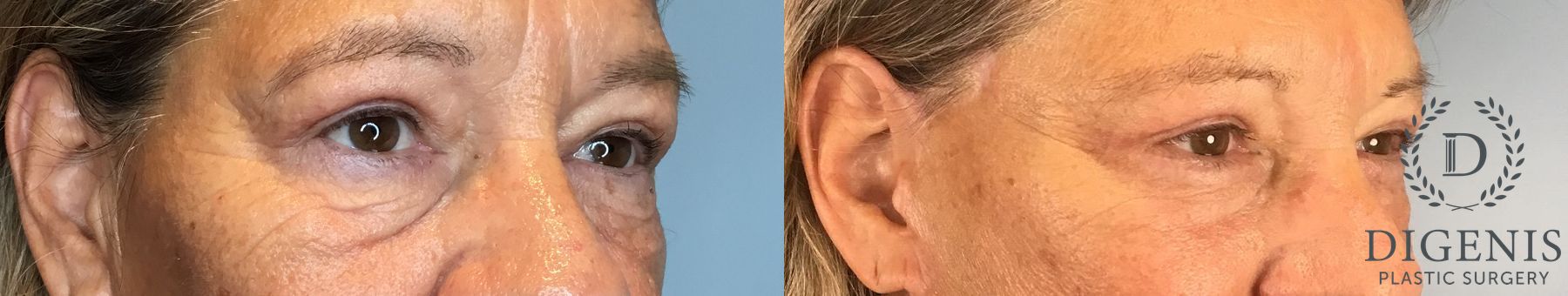 Before and after Eye Lid Surgery case 41927 - Angle 5