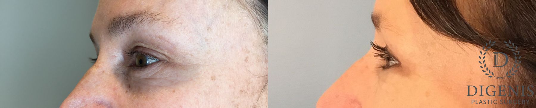 Before and after Eye Lid Surgery case 43361 - Angle 4