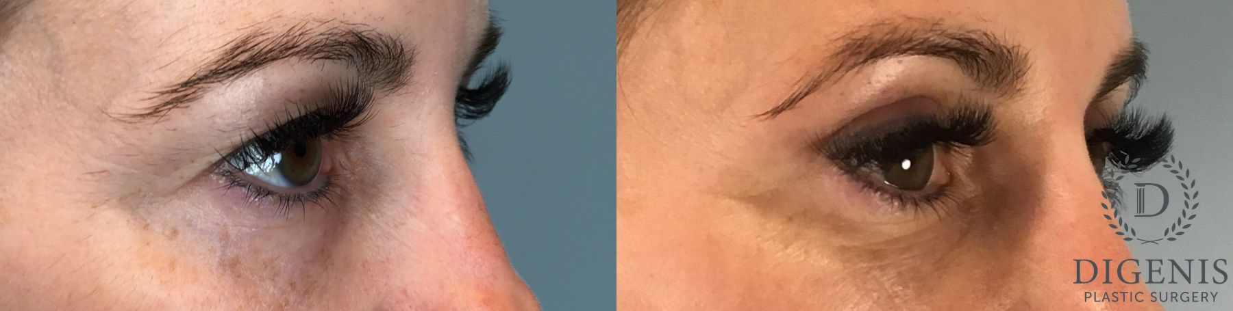 Before and after Eye Lid Surgery case 41732 - Angle 2