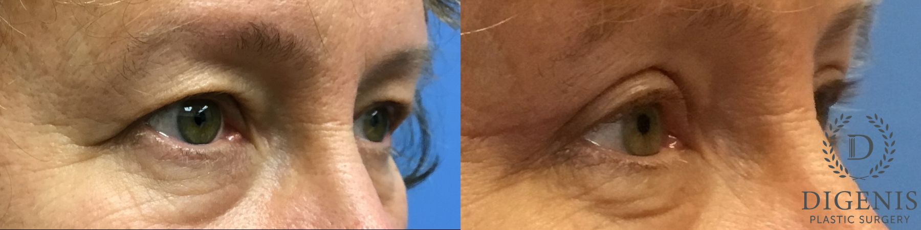 Before and after Eye Lid Surgery case 35092 - Angle 2